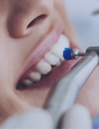 Close up of a dental patient getting a professional teeth cleaning