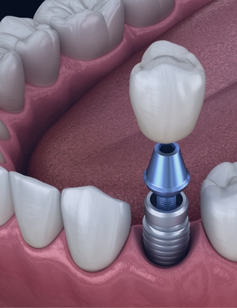Illustration of crown being attached to dental implant